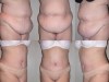 photos-abdominoplastie